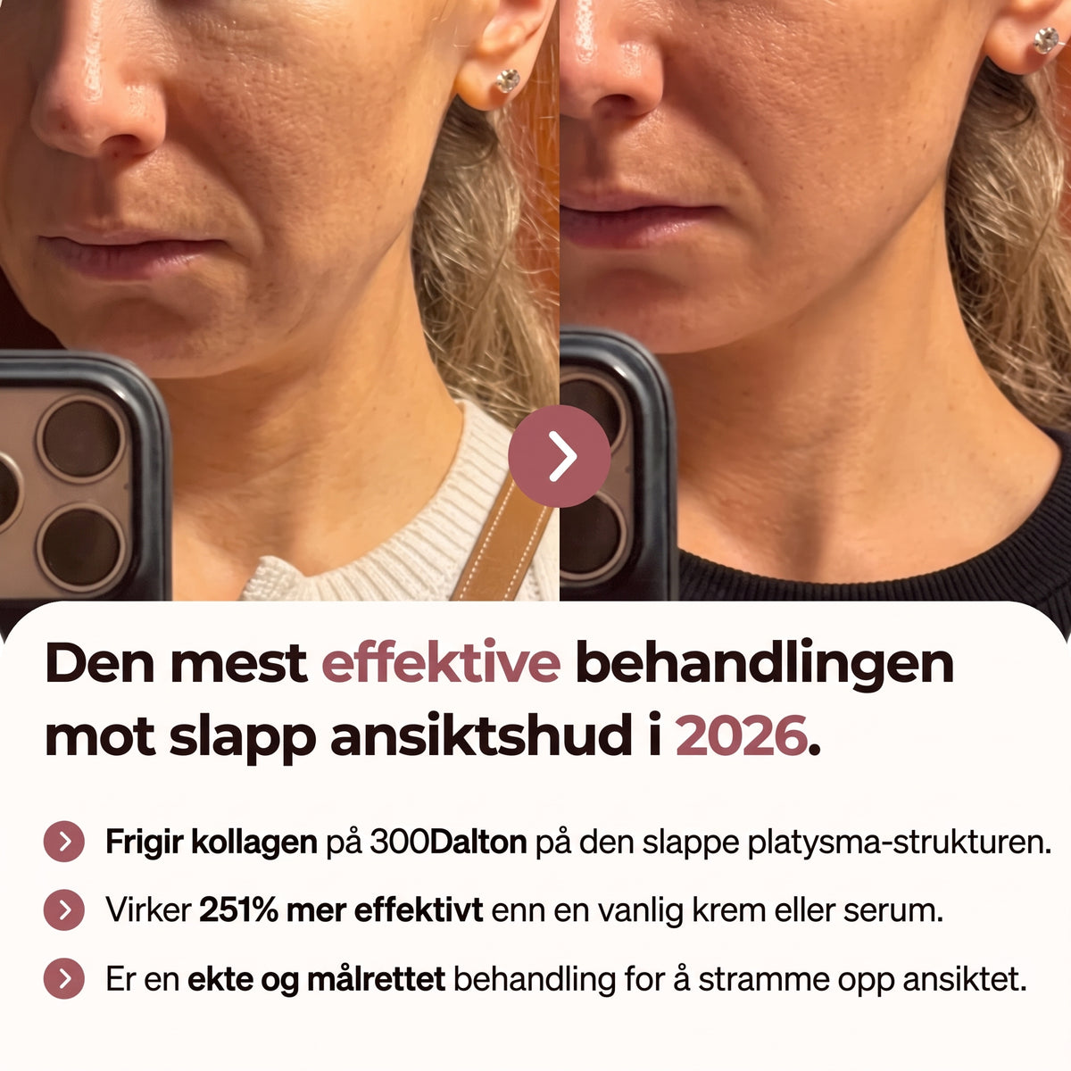 kompresjonsenhet med frigjøring av 300 dalton kollagen