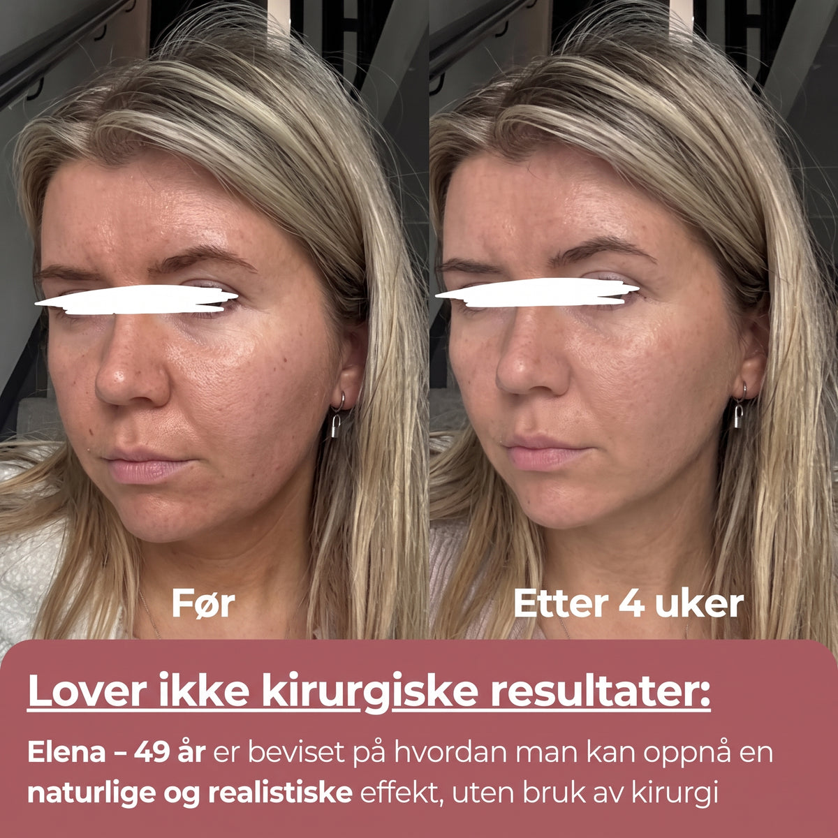 kompresjonsenhet med frigjøring av 300 dalton kollagen